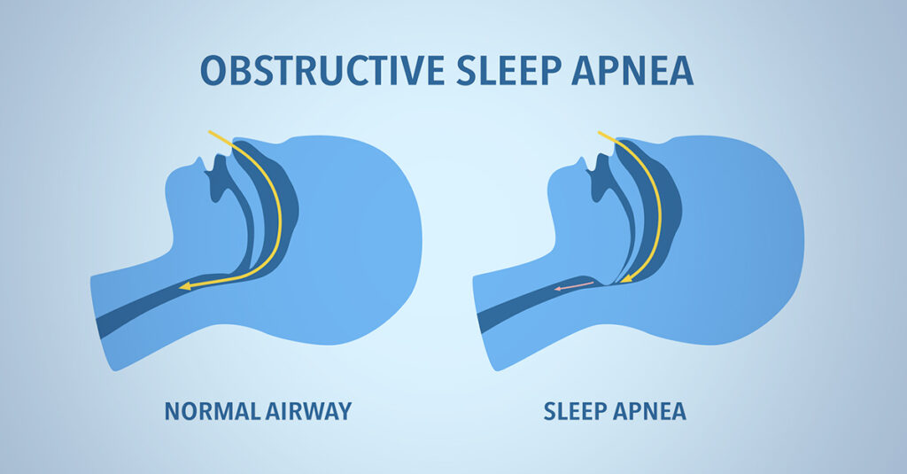 diagram comparing a normal airway and obstructive sleep apnea, showing blocked airflow
