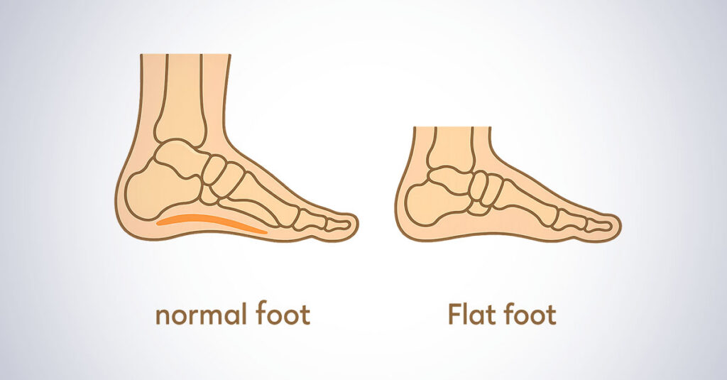 VA rating for flat feet illustration.