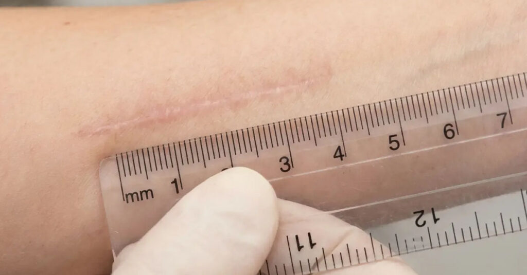 VA rating for scars measurement requirements.