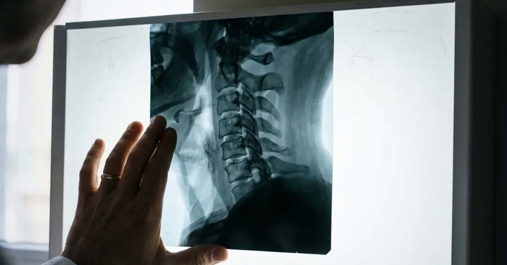 X-ray showing degenerative arthritis in the neck.